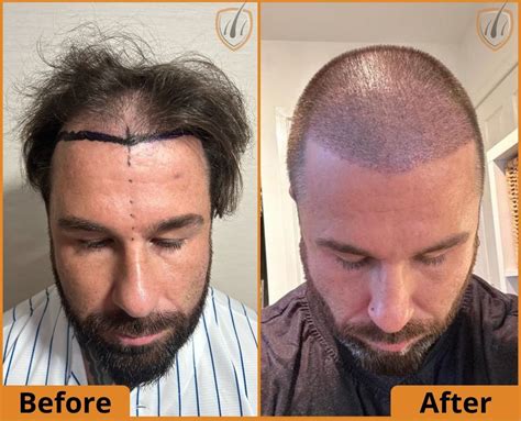 albuquerque hair transplant|THE BEST 10 Hair Loss Centers in ALBUQUERQUE, NM .